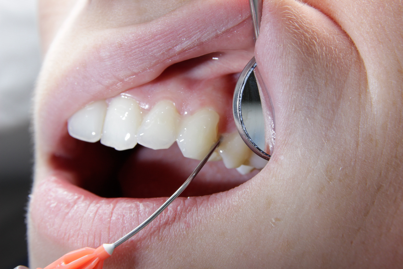 profluoridvarnish_1 dentalspiegel