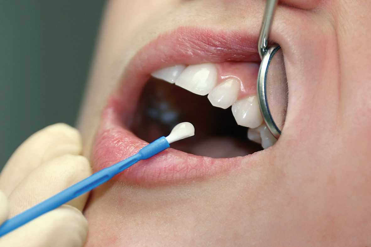 profluorid_varnish_2 dentalspiegel