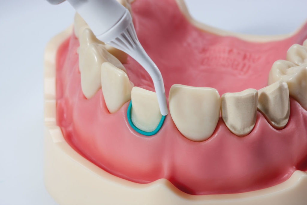 Retraktion leichter gemacht – mit der neuen DMG Retraction Paste