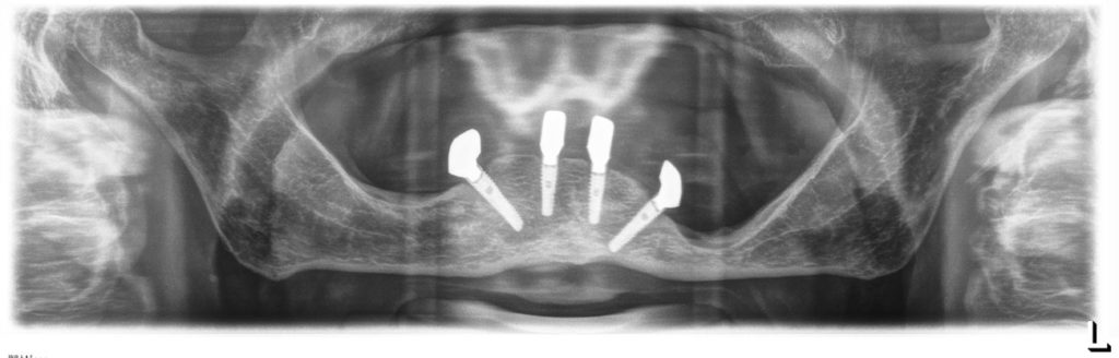 Dentale Rehabilitation zahnloser Patienten nach dem All-on-4-Konzept
